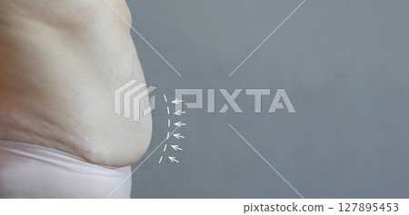 Weight loss and aesthetic surgery concept. Female Belly close up on gray background Weight loss and aesthetic surgery concept. Female Belly close up on gray background 127895453