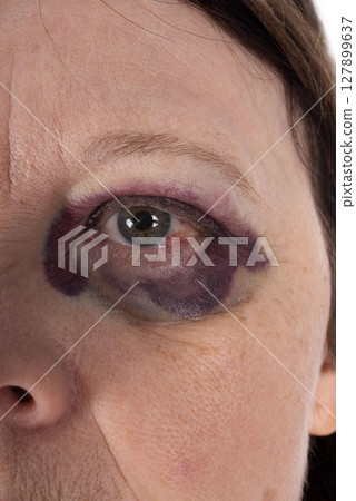black eye on woman black eye on woman 127899637