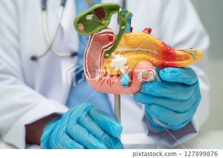 Pancreatitis, pancreatic cancer, Asian doctor with pancreas, gallbladder and bile duct human anatomy model at hospital. 127899876