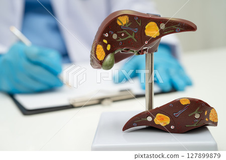 Cirrhosis, Liver cancer, fatty liver, Asian doctor with liver human anatomy model in World Hepatitis Day at hospital. 127899879