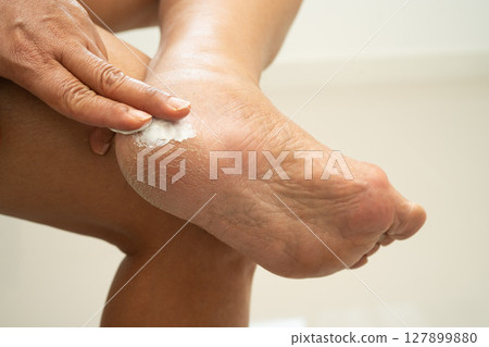Asian woman applying moisturizing cream skincare treatment to solve and repair feet with crack and dry heel skin. 127899880