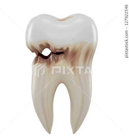 Decayed Molar with a Cavity Minimalist 3D Rendering in a Soft And Smooth Renderer 127922546
