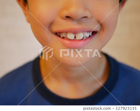 Smiling boy's front teeth 127923135