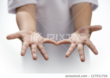Hand, foot and mouth disease HFMD Human hand of scarlet fever in coxsackievirus palmarosa virus and child hand on white background Hand, foot and mouth disease HFMD Human hand of scarlet fever in coxsackievirus palmarosa virus and child hand on white background 127931708