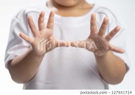 Hand, foot and mouth disease HFMD Human hand of scarlet fever in coxsackievirus palmarosa virus and child hand on white background Hand, foot and mouth disease HFMD Human hand of scarlet fever in coxsackievirus palmarosa virus and child hand on white background 127931714