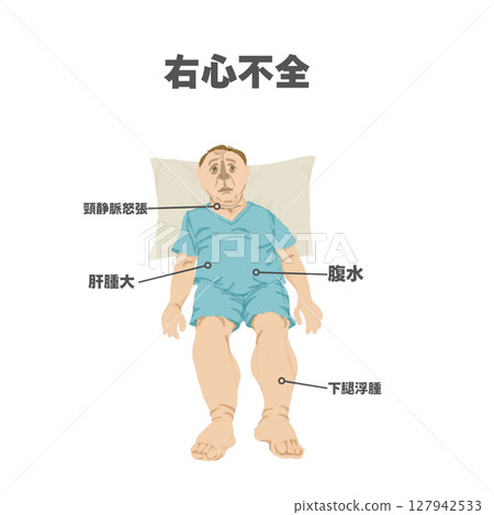 Physical findings of right heart failure (illustration) 127942533