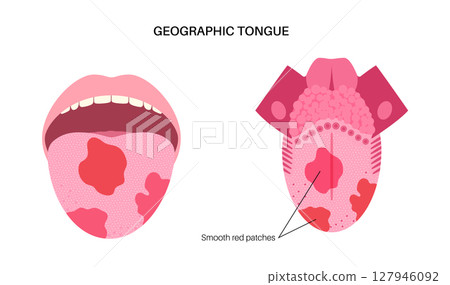 Geographic tongue poster Geographic tongue poster 127946092