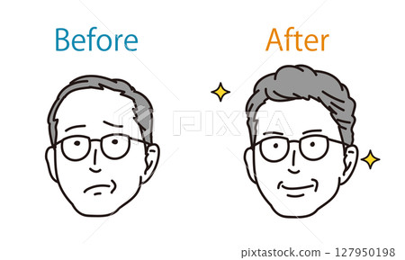 一位患有頭髮稀疏和頭髮問題的男士的治療前後對比圖 一位患有頭髮稀疏和頭髮問題的男士的治療前後對比圖 127950198