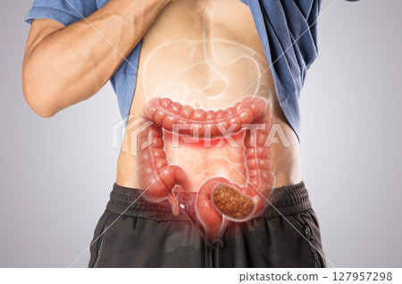 Medical illustration of constipated colon in human abdomen. Ideal for health and education. 127957298