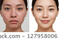Comparison image of a woman with a lot of acne and a woman without acne 127958006