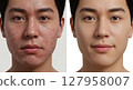 Comparison image of a man with a lot of acne and a man without acne 127958007