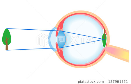 Structure of the eye: Refraction of normal vision Structure of the eye: Refraction of normal vision 127961551