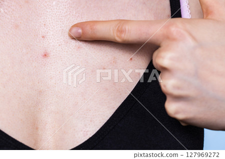 Woman having pimples red spots on chest Woman having pimples red spots on chest 127969272