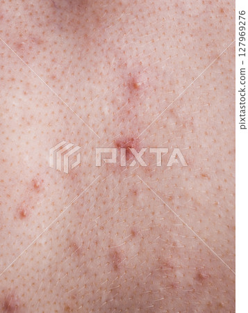 Closeup human skin with problem 127969276
