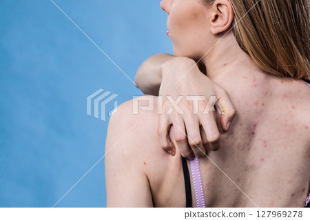 Woman with skin problem acne on back 127969278