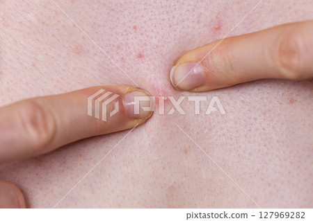 Woman dealing with pimples red spots Woman dealing with pimples red spots 127969282
