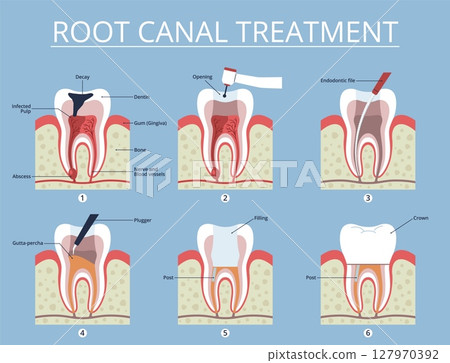 Root canal treatment stages. Dental educational schemes, gradual caries sealing and filling, tooth in section, anatomical infographics banner for stomatology clinic, nowaday vector concept Root canal treatment stages. Dental educational schemes, gradual caries sealing and filling, tooth in section, anatomical infographics banner for stomatology clinic, nowaday vector concept 127970392