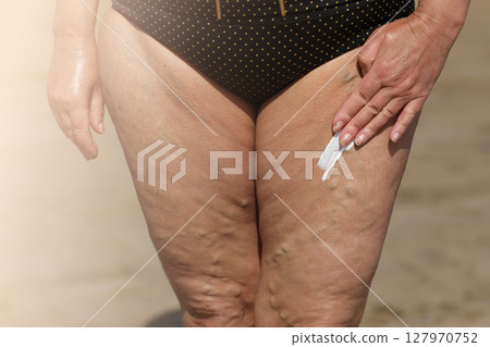 overweight woman applying sunscreen lotion on her legs with varicose veins, close up detail. vacation on sea beach. overweight woman applying sunscreen lotion on her legs with varicose veins, close up detail. vacation on sea beach. 127970752