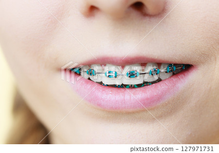 Closeup of woman teeth with braces Closeup of woman teeth with braces 127971731