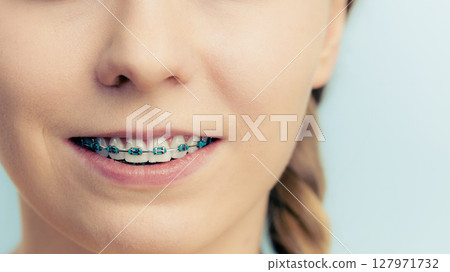 Woman showing her teeth with braces Woman showing her teeth with braces 127971732