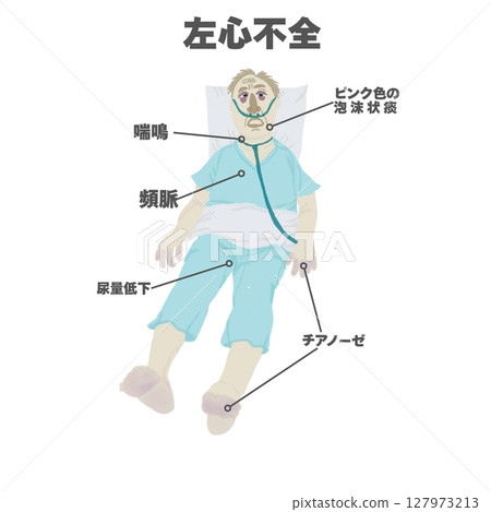 Physical findings of left ventricular failure (illustration) 127973213