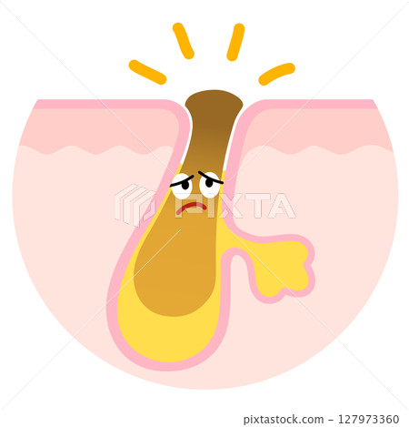 Pores clogged with keratin plugs character 127973360