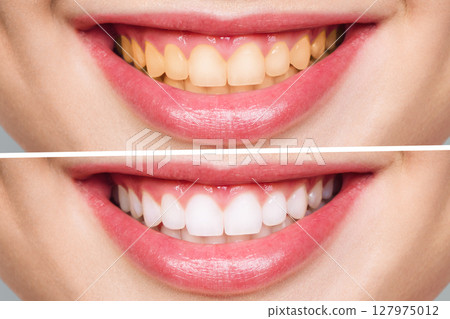 Teeth Whitening Transforming Your Appearance Before and After for Stunning Results 127975012