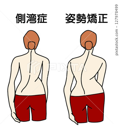 Illustration of a woman with S-shaped scoliosis posture seen from behind 127978499