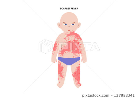 Scarlet fever child Scarlet fever child 127988341