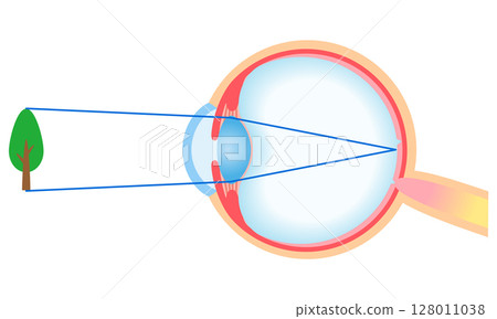 Structure of the eye: Refraction of normal vision 128011038