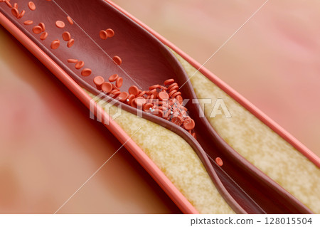 Arteriosclerosis: 3DCG cross-section of cholesterol and blood flow that narrows blood vessels Arteriosclerosis: 3DCG cross-section of cholesterol and blood flow that narrows blood vessels 128015504