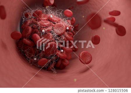 導致腦梗塞的血管血栓的 CG 插圖 128015506