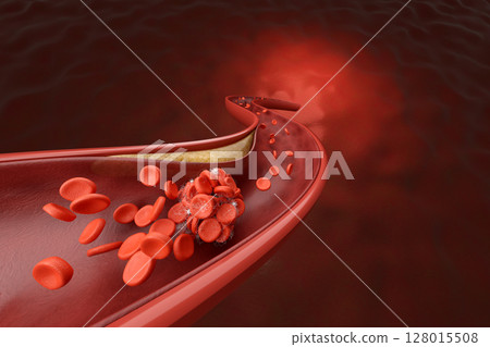 動脈硬化膽固醇阻塞血管和紅血球的3DCG插圖 128015508
