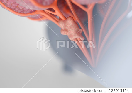 Breast cancer tumor image 3DCG illustration 128015554