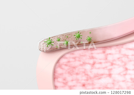感染癬菌的影像，導致灰指甲 CG 趾甲橫斷面 128017298