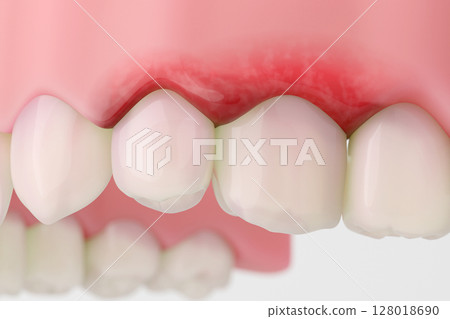 牙周病的症狀 牙齦發炎的 3DCG 插圖 牙周病的症狀 牙齦發炎的 3DCG 插圖 128018690