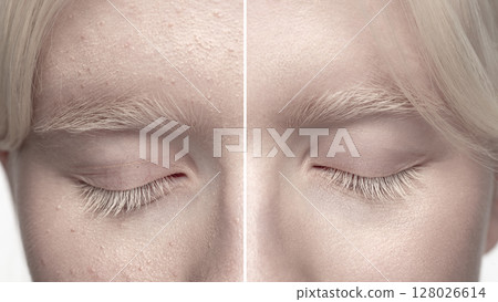 Albino woman skin macro comparison: before and after beauty skin retouch. Dermatology procedure 128026614