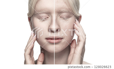 Close-up beauty portrait of a young albino woman with split-screen before and after skin cosmetic procedures 128026623