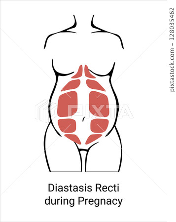Different types of Diastasis. Diastasis in a woman before, during and after pregnancy. The anatomy of a Woman. A woman's muscular corset before and after childbirth. Vector illustration Different types of Diastasis. Diastasis in a woman before, during and after pregnancy. The anatomy of a Woman. A woman's muscular corset before and after childbirth. Vector illustration 128035462