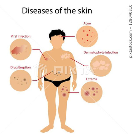illustration of biology and medical, Diseases of the skin, Skin disorders vary greatly in symptoms and severity, Pictures of different skin disorders, Chronic skin disease illustration of biology and medical, Diseases of the skin, Skin disorders vary greatly in symptoms and severity, Pictures of different skin disorders, Chronic skin disease 128040810