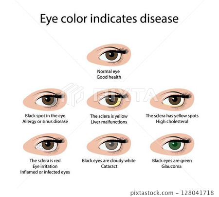 illustration of biology and medical, Eye color indicates disease, Signs of unhealthy eyes, Abnormal eye color indicates health or disease, eye infection, signs of health illustration of biology and medical, Eye color indicates disease, Signs of unhealthy eyes, Abnormal eye color indicates health or disease, eye infection, signs of health 128041718