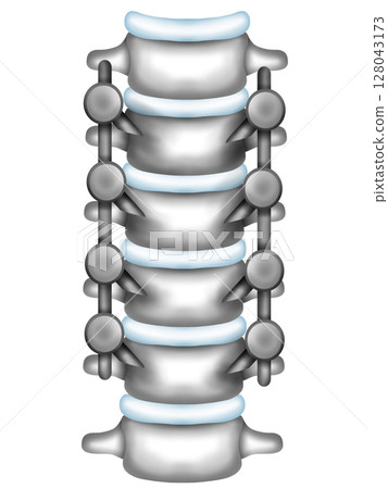 Scoliosis correction surgery using spinal instrumentation Scoliosis correction surgery using spinal instrumentation 128043173