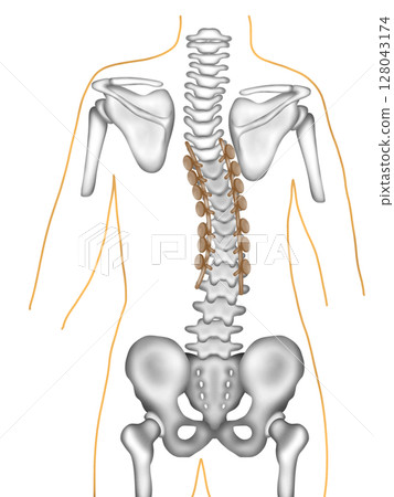 Scoliosis correction surgery using spinal instrumentation Scoliosis correction surgery using spinal instrumentation 128043174