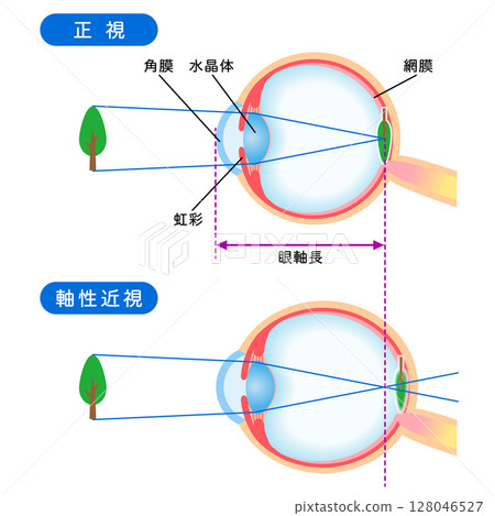 眼睛的結構：正常視力與軸性近視、視力 128046527