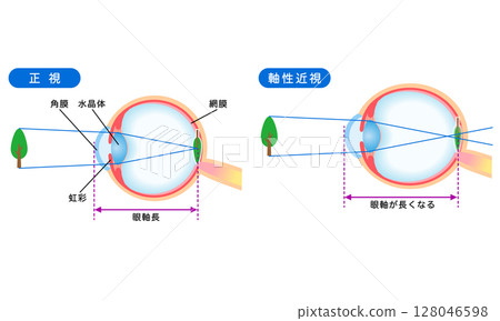 Structure of the eye: normal vision and axial myopia, visual acuity Structure of the eye: normal vision and axial myopia, visual acuity 128046598