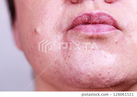 Female face with acne skin problem Female face with acne skin problem 128061521