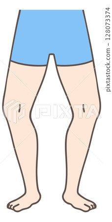 Bow-leggedness, external rotation of the legs Bow-leggedness, external rotation of the legs 128073374