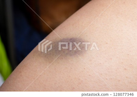 A persons arm that features a noticeable purple spot on it 128077346