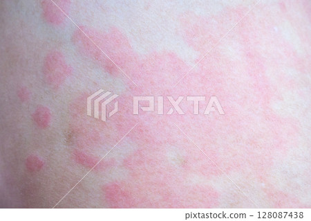Skin allergy rash dermatitis texture close up Skin allergy rash dermatitis texture close up 128087438