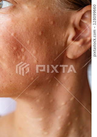 Woman's face after mesotherapy injections biorevitalization. Woman's face after mesotherapy injections biorevitalization. 128099660